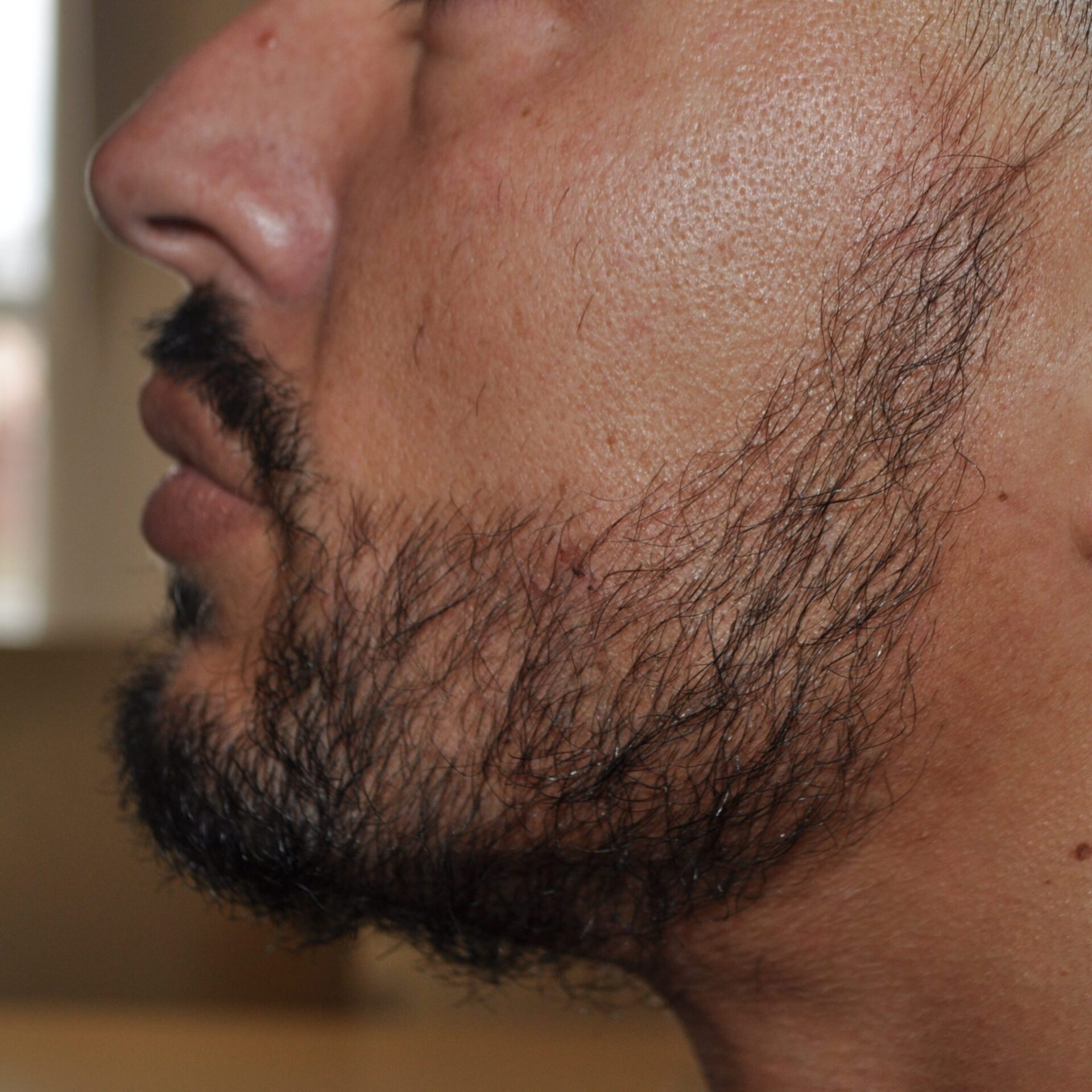 Beard-Transplant-1800-grafts-scaled