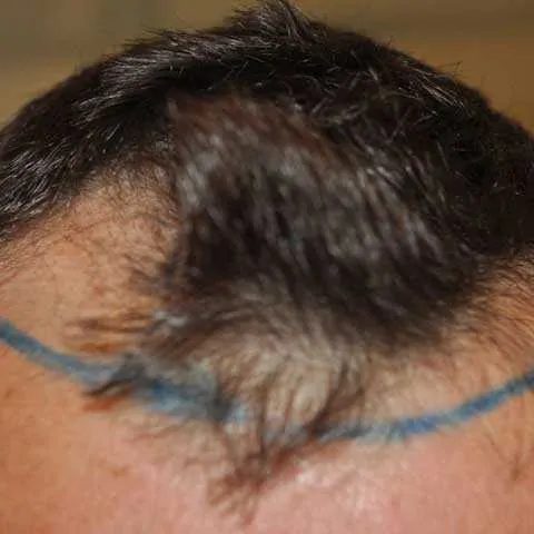 FUE-Before-1500-Grafts
