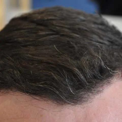 FUE-Fontal-Hairline-1500-grafts-1
