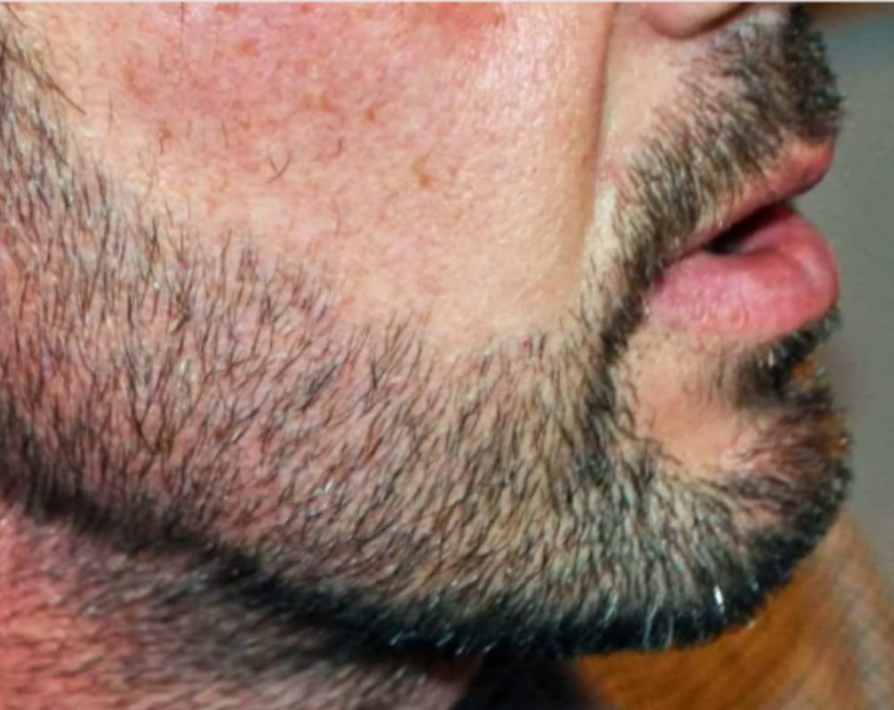FUE-beard-transplant-result
